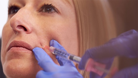 Femme se faisant injecter un produit de comblement à l'acide hyaluronique dans une ride d'expression du visage